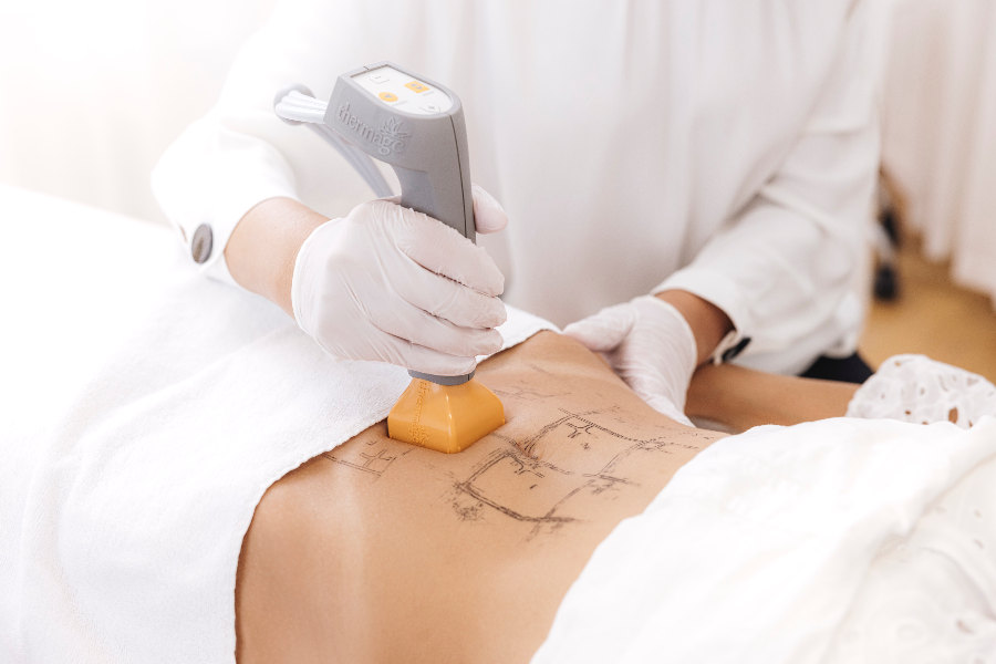 Rejuvenate Your Body with Thermage: The Non-Invasive Solution for Body Contouring